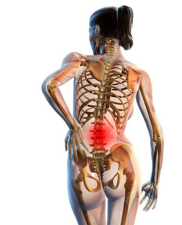 A osteocondrose da columna lumbar é a máis común