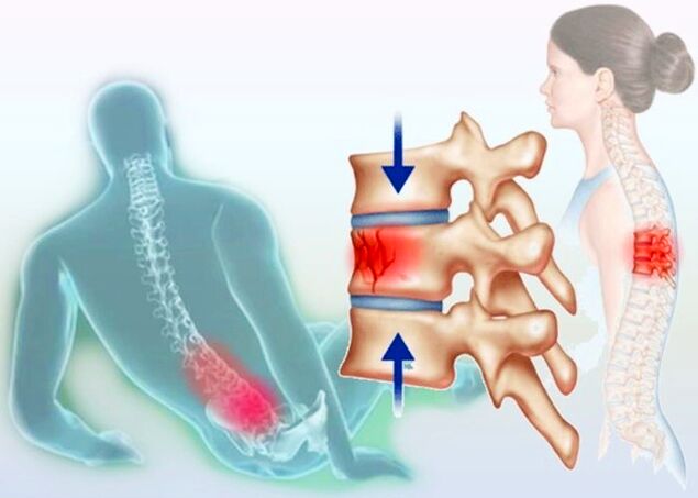 Incluso unha lesión común pode desencadear o desenvolvemento da osteocondrose