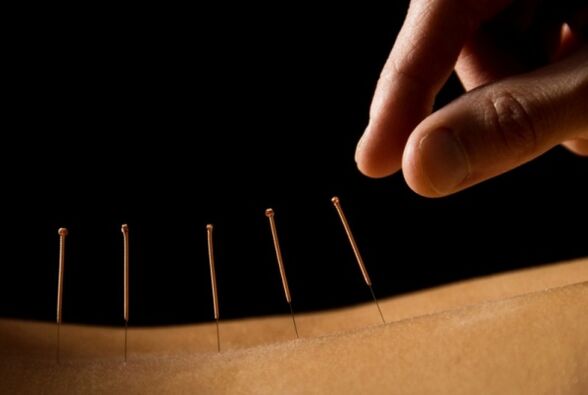 A acupuntura axuda a desfacerse da dor lumbar