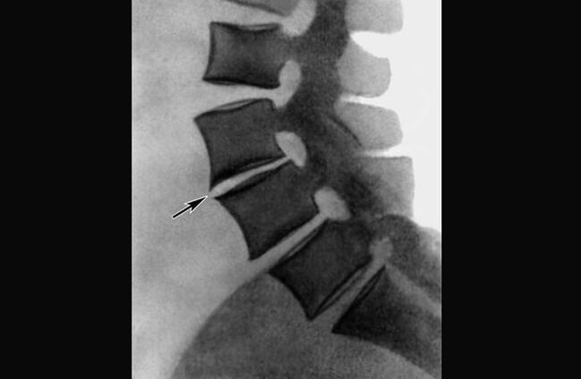 Manifestacións da osteocondrose da columna vertebral torácica na radiografía